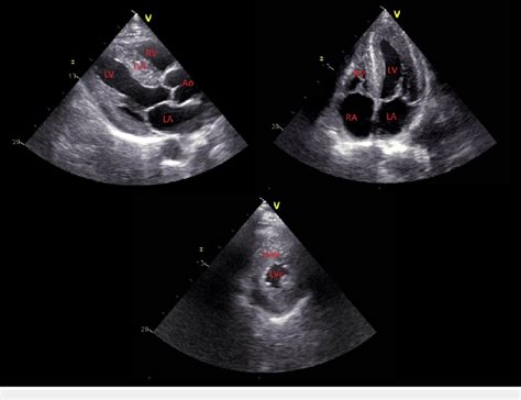 lv echocardiogram|echocardiogram lv function.